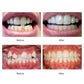 Teeth Trainer Dental Appliance Orthodontic Brace